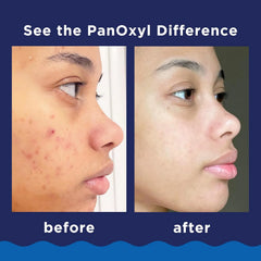 PanOxyl Acne Foaming Wash for face & body Benzoyl Peroxide 10% Maximum Strength Antimicrobial, 3 oz. - Travel Size